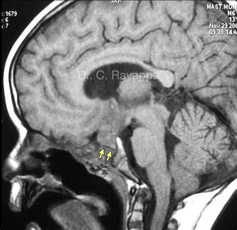 Skull Base Surgery in Children | Head & neck cancer surgeon