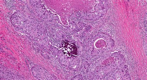 Salivary duct carcinoma | Ottawa Atlas of Pathology