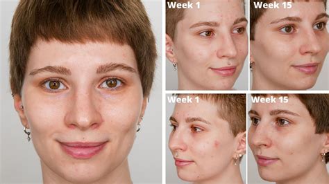 The Ordinary Before and After Acne With Pictures 4 Months - YouTube