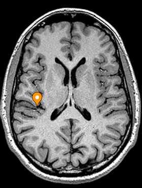 Telencephalon - e-Anatomy - IMAIOS