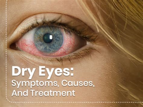 Dry Eyes: Symptoms, Causes, Risk Factors, Treatment And Prevention ...