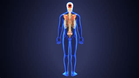 Diffuse Idiopathic Skeletal Hyperostosis Overview