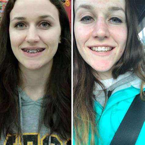 I Just Got My Braces Off! It’s Been Two Years And Two Fake Teeth And ...