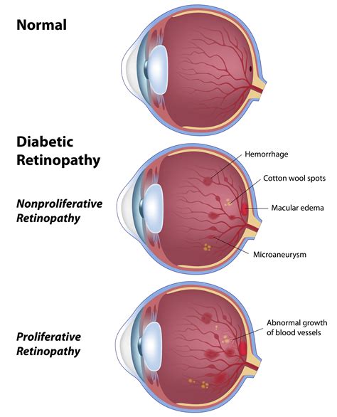 Diabetic Retinopathy | Petrou Eye Care