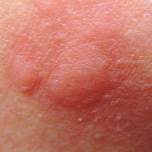 Mosquito Bites – Pictures, Itch, Swelling, Prevention and Treatment