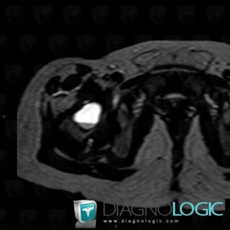 Radiology case : Simple bone cyst (MRI) - Diagnologic