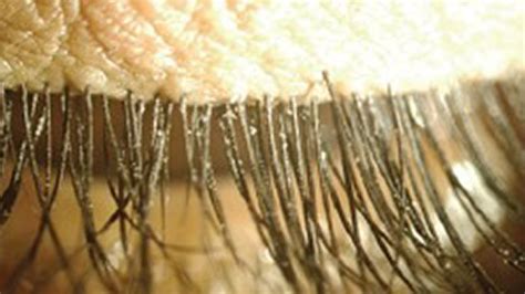 Demodex Mites Hair Loss - The Relation Between Alopecia And Demodex Mites Ungex - clamoerland