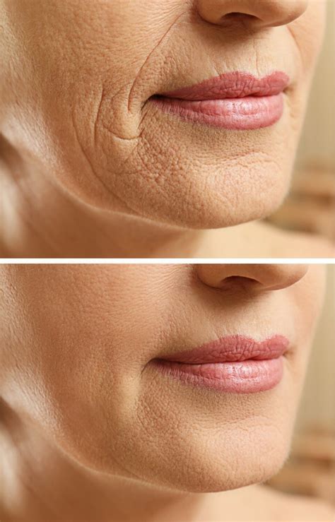 Anti-aging behandeling: Microneedling - Laserkabinet Herentals: laserbehandelingen & medisch ...