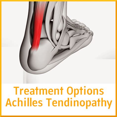 Treatment for Insertional Achilles Teninopathy - Sports Medicine Review