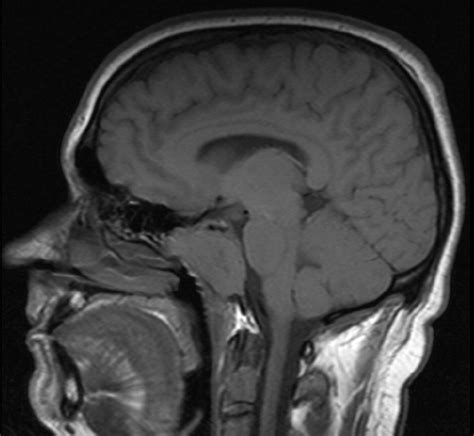 Benign and malignant diseases of the clivus - Clinical Radiology