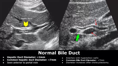 Sonographic Measurement Of Normal Common Bile Duct Diameter, 40% OFF