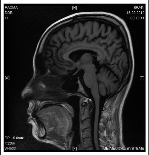 MRI Brain showing empty sella (red arrow) in our patient. | Download Scientific Diagram