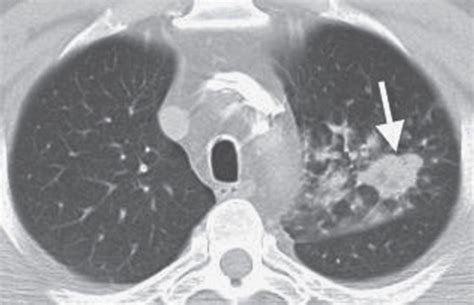 Solitary and Multiple Pulmonary Nodules | Radiology Key