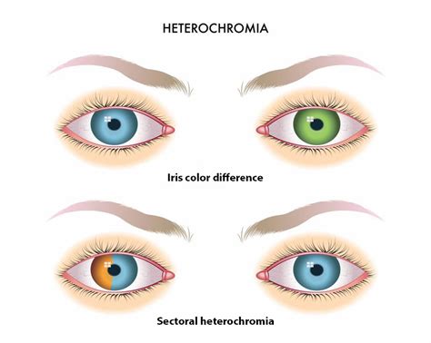 All You Need To Know About Heterochromia Obn - vrogue.co