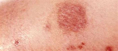 Brown Recluse Spider Bite Symptoms | Brown Recluse Venom | Orkin