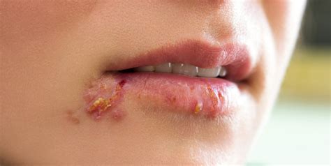 Herpes Labialis - Dr. Walia's Skin And Laser Clinic