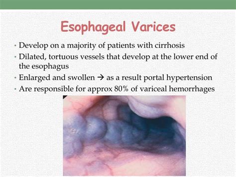 Esophageal Varices