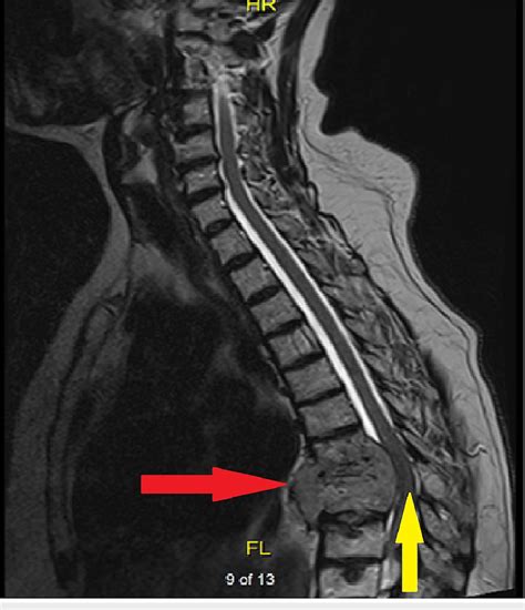 Plasmacytoma with spinal cord compression. Sagittal view of thoracic ...