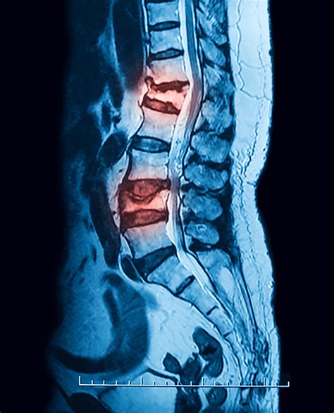 Vertebral Compression Fracture Treatment in NJ and NYC | Premier Brain & Spine