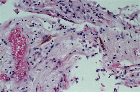 Light Micrograph Of Asbestos Fibres In Lung Tissue Photograph by Dr. E ...