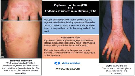 What are the causes of erythema multiforme?