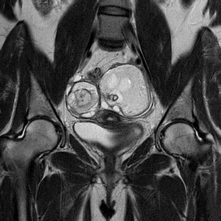 Bilateral ovarian dermoid cysts | Radiology Case | Radiopaedia.org