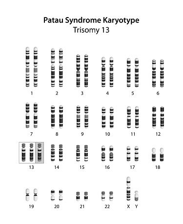 Patau Syndrome Karyotype Stock Illustration - Download Image Now - iStock