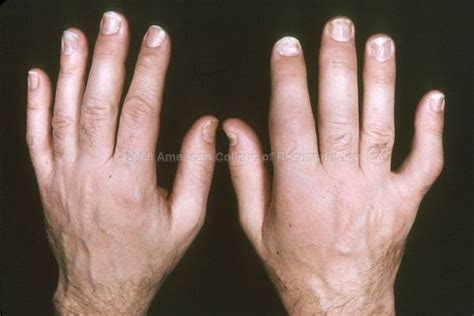 Psoriatic Arthritis Hands | Psoriatic Arthritis | Pinterest