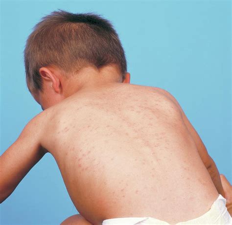 Measles Rash Photograph by Alex Bartel/science Photo Library - Fine Art America