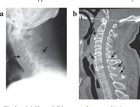 Figure 1 from Incidental discovery of an intradural extramedullary tumor during imaging studies ...