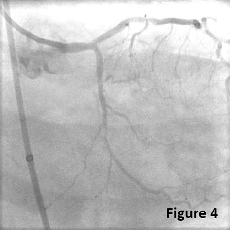 Acute Stent Thrombosis - Cardiology Apps