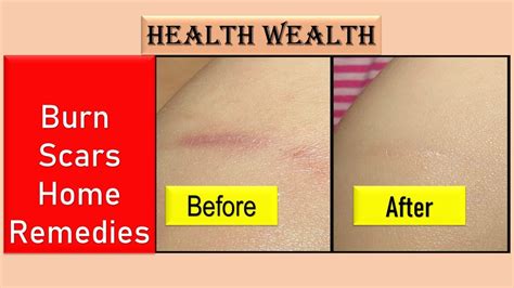 Burn Scars Treatment | Burn Scars Removal | Get Rid Burns Scars (Marks) Treatment Home Remedies ...