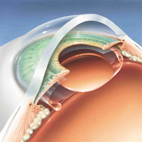 ICL Surgery: Meaning, Procedure, Benefits, Risks And Limitations