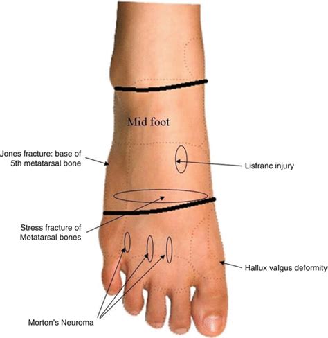 The Foot | Musculoskeletal Key