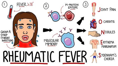 Rheumatic Fever Made Easy (Including Jones Criteria and Mnemonic!) - YouTube