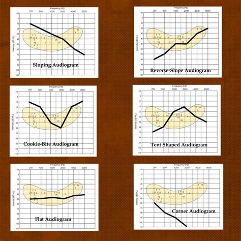 The Best Hearing Loss Simulations: Understanding Audiograms and the Impact of the Speech Banana ...