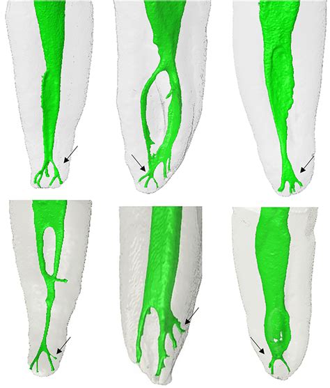 D models of human teeth showing the variability of the root canal... | Download Scientific Diagram