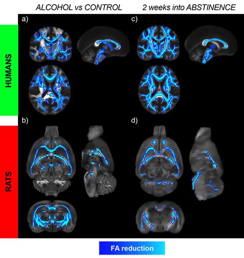 Alcohol-induced brain damage continues after alcohol is stopped