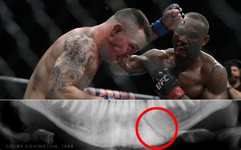 A look at Colby Covington's broken jaw X-ray