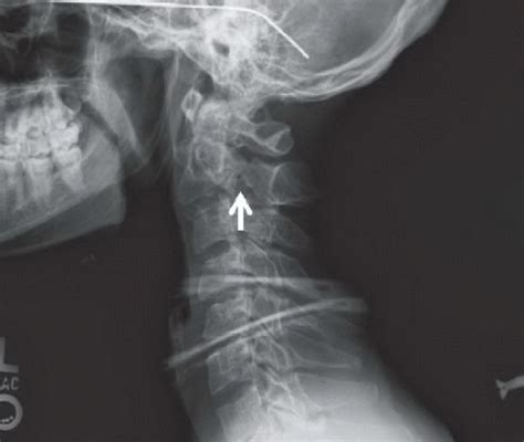 Hangman Fracture | Radiology Key