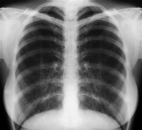 What Is a Tuberculosis Chest X-Ray? (with pictures)