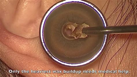 Ear Wax Removal with Mr Blackhead and Watson | Blackhead King - YouTube