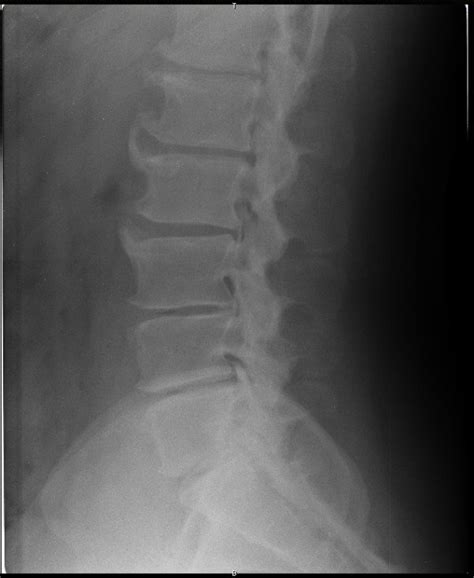 Representative radiograph of anterior lumbar vertebral osteophytes; 72... | Download Scientific ...