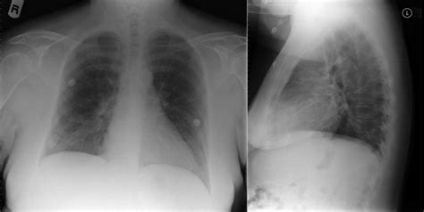 Heart Failure | Radiology Key