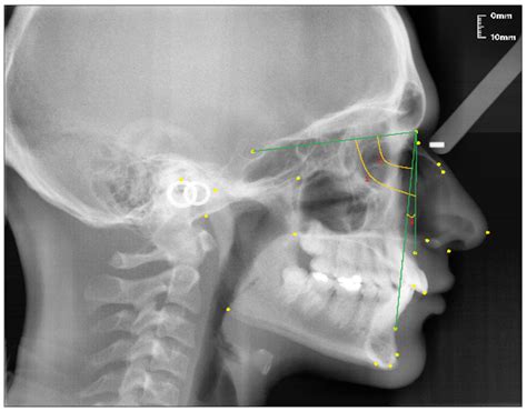 Nasal Bone X Ray Anatomy