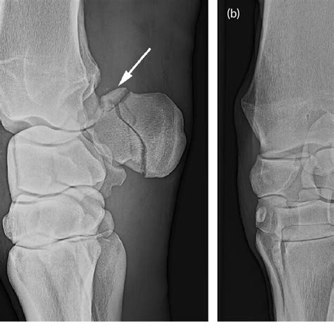 APTUS® 3.5 talonavicular fusion plate (a) and the olive pin (b). Note ...