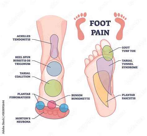 Foot pain causes from zones diagnosis and painful spots areas outline diagram. Labeled ...