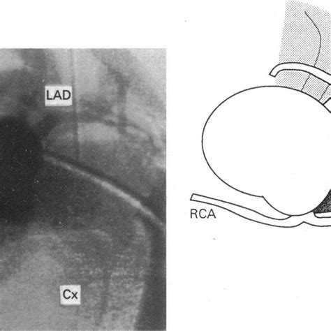 End-on aortogram with catheter (C) in main pulmonary artery. This... | Download Scientific Diagram