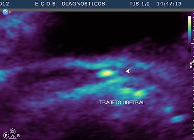 ECOGRAFIA: UROLOGIA - CARÚNCULA URETRAL