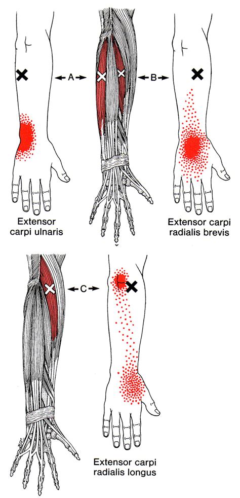 Extensor Carpi Radialis Brevis | The Trigger Point & Referred Pain Guide